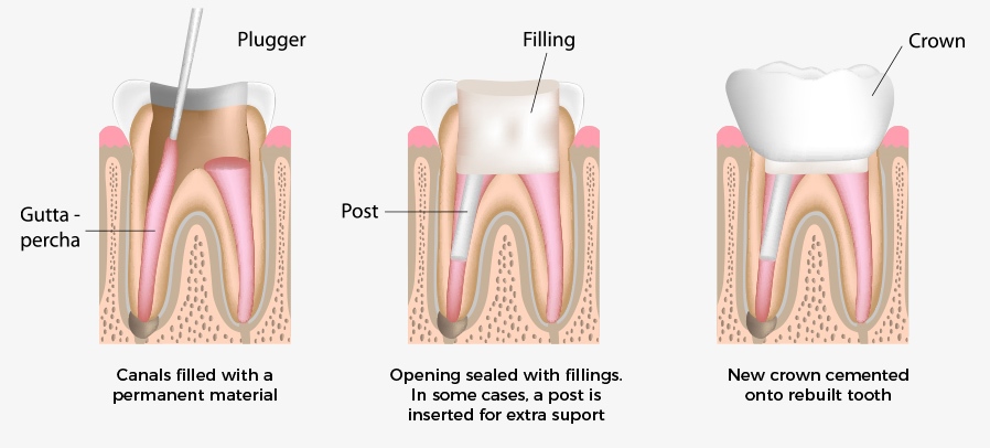 photo of 3 option in root canal treatment including crown
