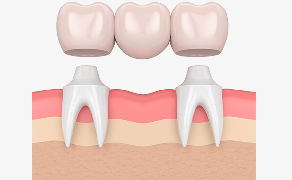 The Smile Workx - Dental Crowns and Bridges