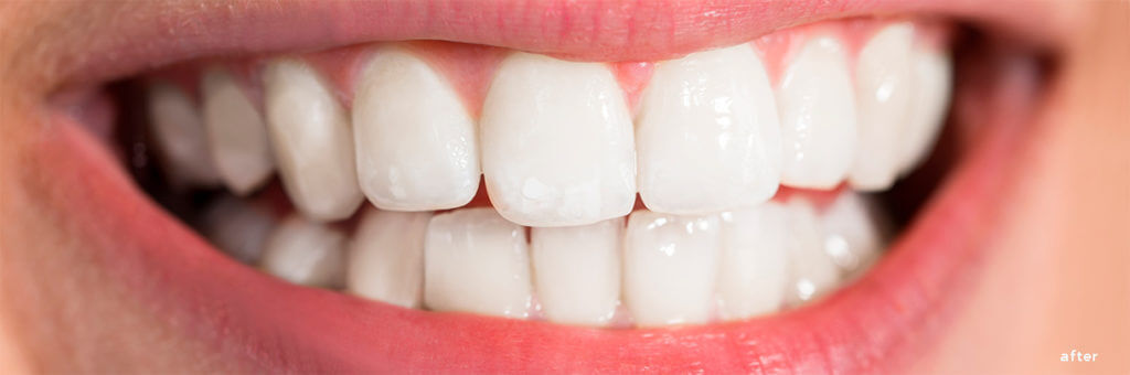 The Smile Workx - Dental Services - Cosmetic Dentistry Teeth Whitening After