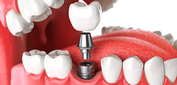 The Smile Workx - Dental Services - Dental Implant Sample2