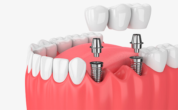 The Smile Workx - Implant Supported Crowns and Bridges