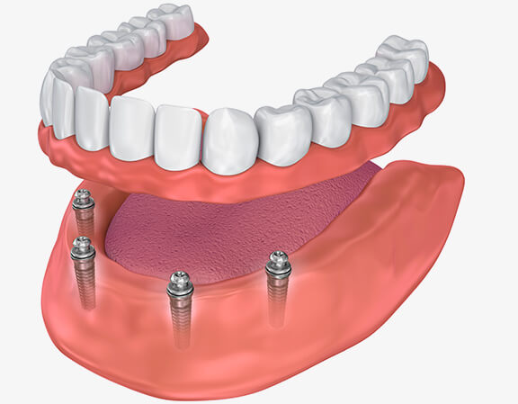 The Smile Workx - Implant Supported Dentures