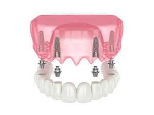all 4 dental implants cost image noosaville