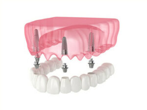 All-on-4-Dental-Implants-image-noosaville