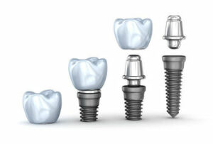 all-on-4-dental-implants-parts-noosaville