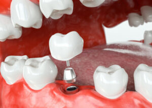 cost of dental implants in Australia noosaville