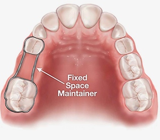 photo of dentures with fixed spaced maintainer