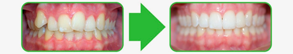 sample nr 1 of before and after braces