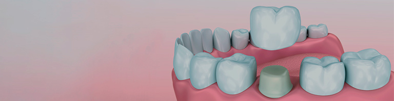 jaw with teeth with a crown over one tooth
