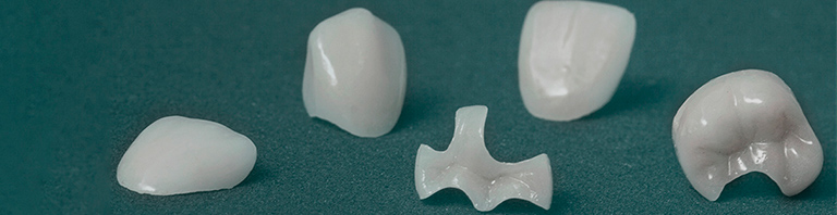 Inlays _ Onlays- Main- Mobile