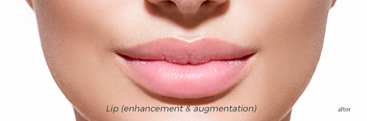 lips with augmentation