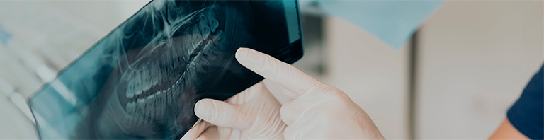 x-ray of a mouth with teeth