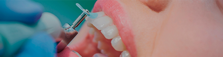 image of the process of teeth polishing