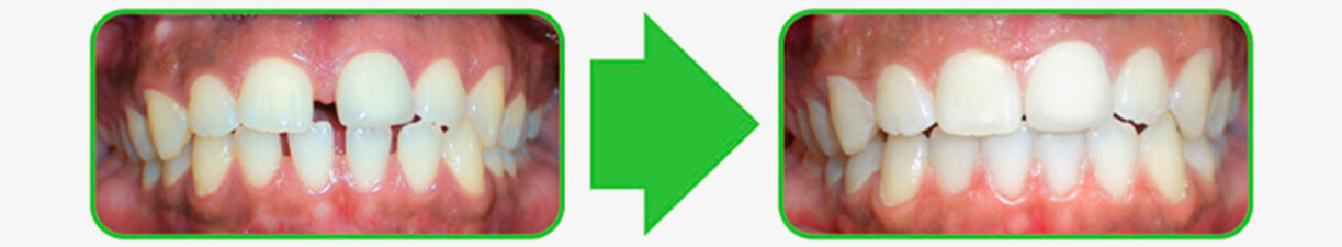 The Smile Workx - Before and After Invisble Braces Teeth Gaps