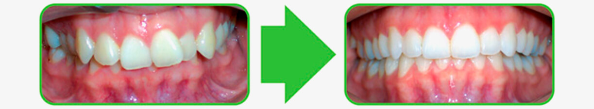 The Smile Workx - Before and After Invisble Braces Use