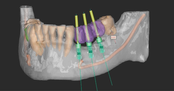 Lower arch dental implants in impression