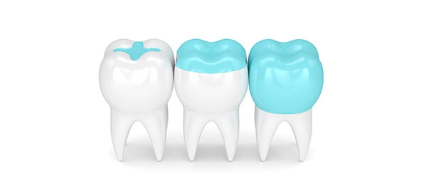 The Smile Workx - Dental Onlays and Inlays Demo