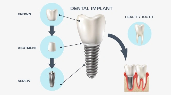 Dental implant infographic with labelled parts: crown, abutment, and screw