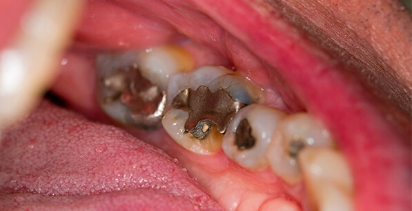 The Smile Workx - Dental Services - Safe Amalgam Removal Services Dental Amalgam