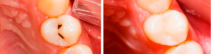 The Smile Workx - General Dentistry - Dental Fillings Sample