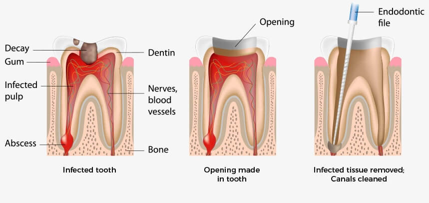 The Smile Workx - General Dentistry Root Canal Treatment