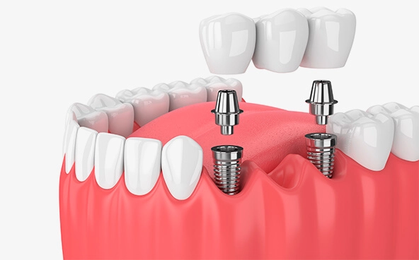 implants Supported Crowns and Bridges