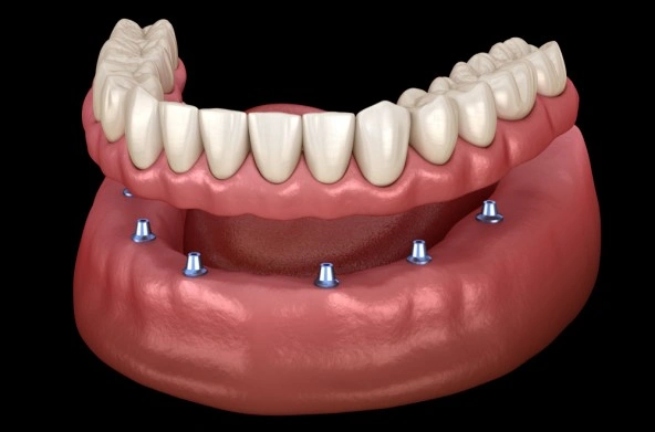 High-quality dentures Noosaville