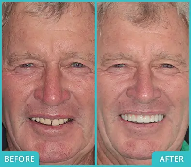 Older patient before and after receiving implant-supported fixed bridge