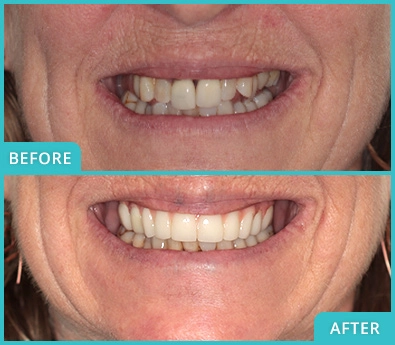 Older woman before and after receiving an implant-supported fixed bridge