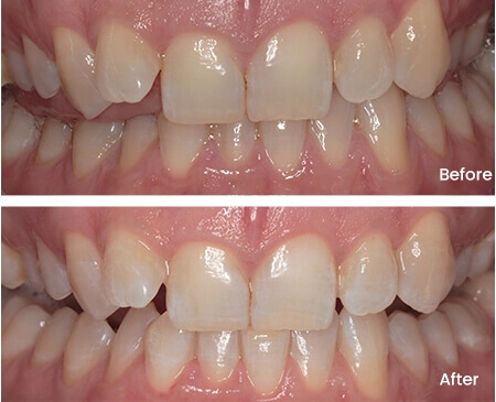 Charmain Fing Teeth Whitening Smile Workx