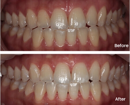 Hollie Teeth Whitening Smile Workx