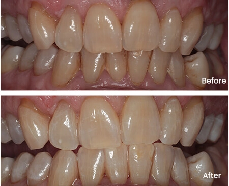 Ian McQuinn Teeth Whitening Smile Workx