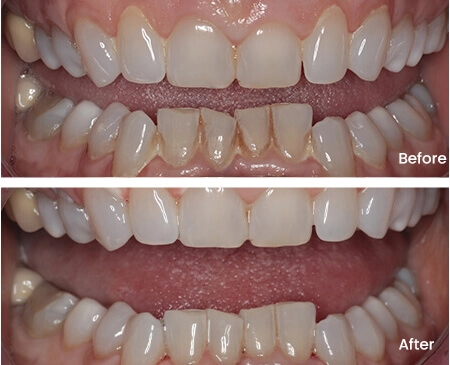 Julia Carlson Teeth Whitening Smile Workx