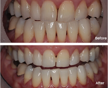Leora Urnes Teeth Whitening Smile Workx