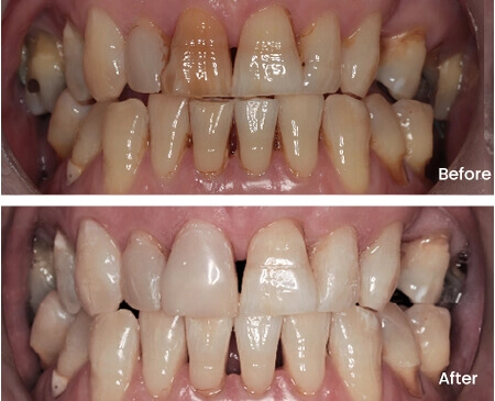 Ron Teeth Whitening Smile Workx