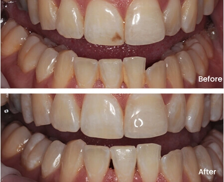 Ryan Fitzpatrick Teeth Whitening Smile Workx