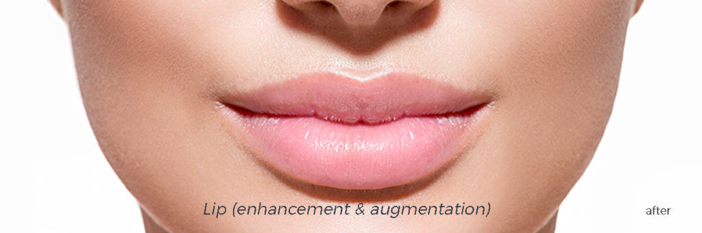 The Smile Workx Anti Wrinkle Injections Dermal Fillers After.jpg