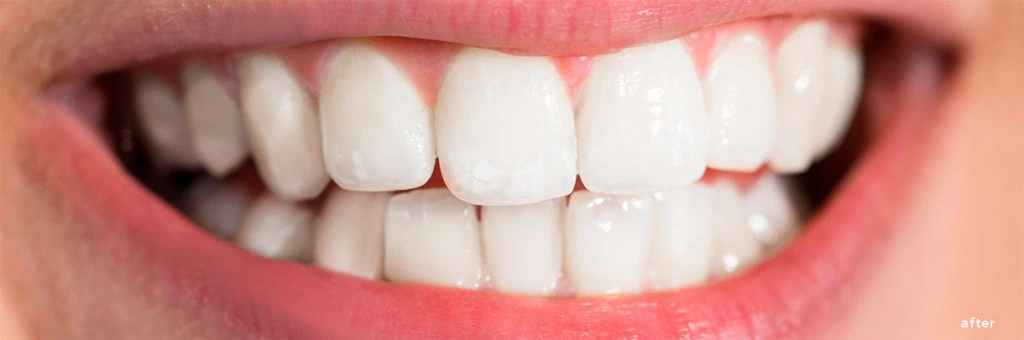 Before and after comparison of a smile following teeth whitening