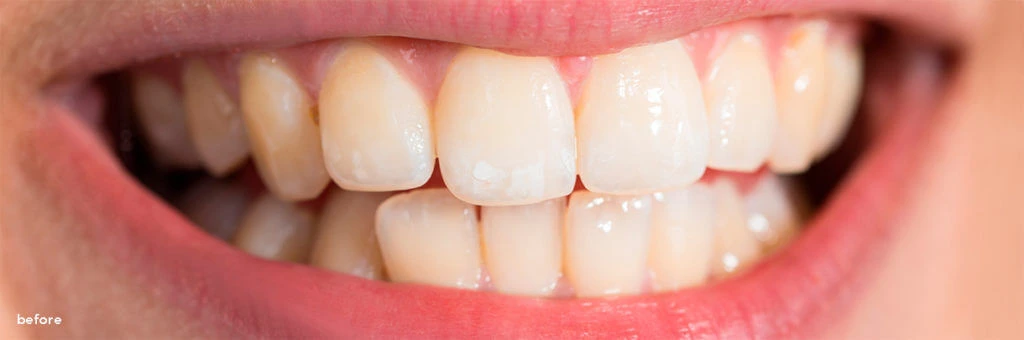 Before and after comparison of a smile following teeth whitening