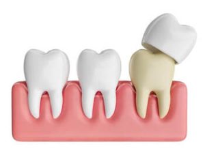What Is a Tooth Filling crown