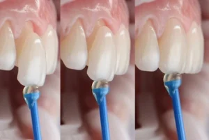 How Do Veneers Work application How Do Veneers Work application