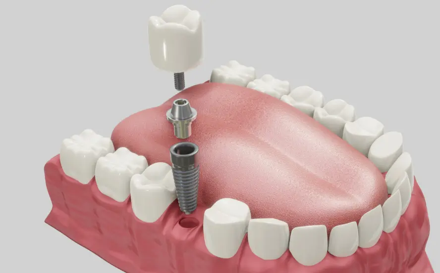 Implant-supported denture shown above implants in the jaw