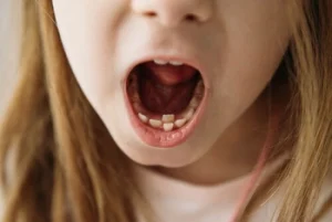 baby tooth knocked out removal