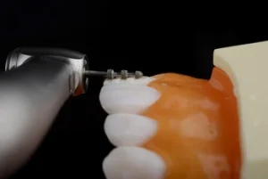 Stained Composite Veneers procedure Stained Composite Veneers procedure