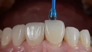 Veneers On Bottom Teeth look like Veneers On Bottom Teeth look like
